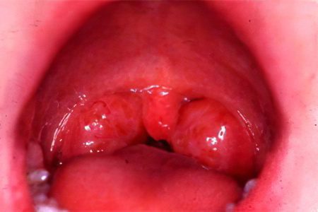 Acute pharyngitis