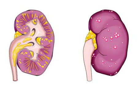 Acute pyelonephritis