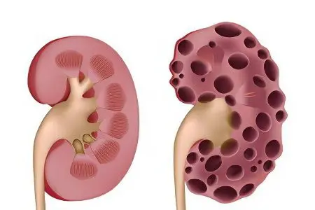 Acute renal failure: symptoms and treatment