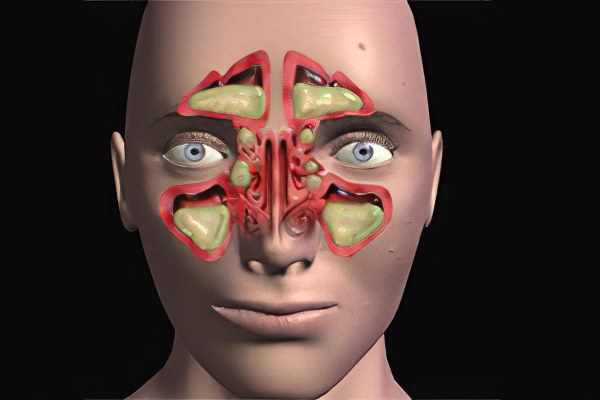 Acute sinusitis &#8211; how and what to treat?