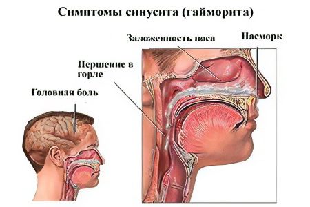 Acute sinusitis - how and what to treat?