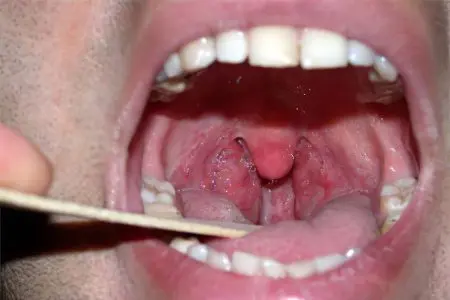 Acute tonsillitis