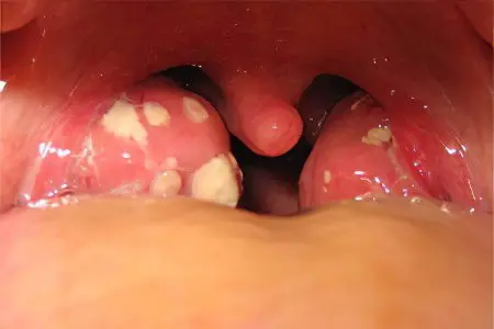 Acute tonsillitis