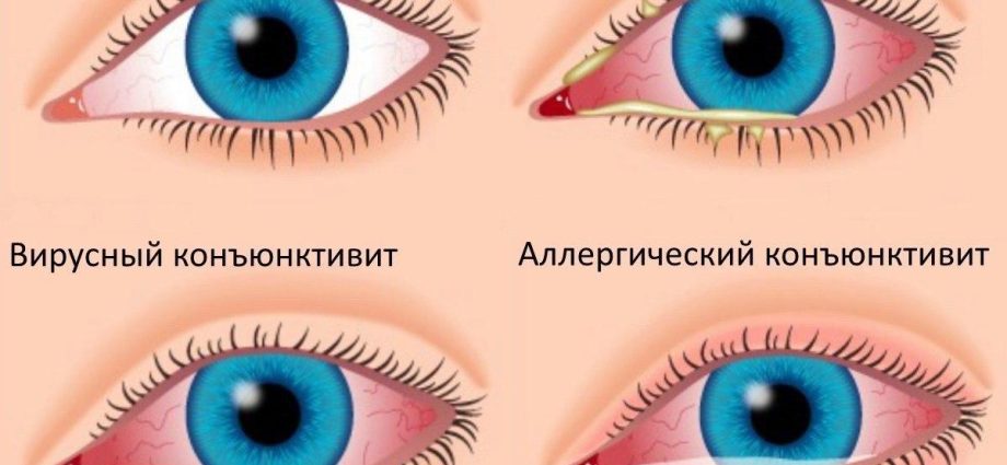 Adenovirus conjunctivitis of the eye