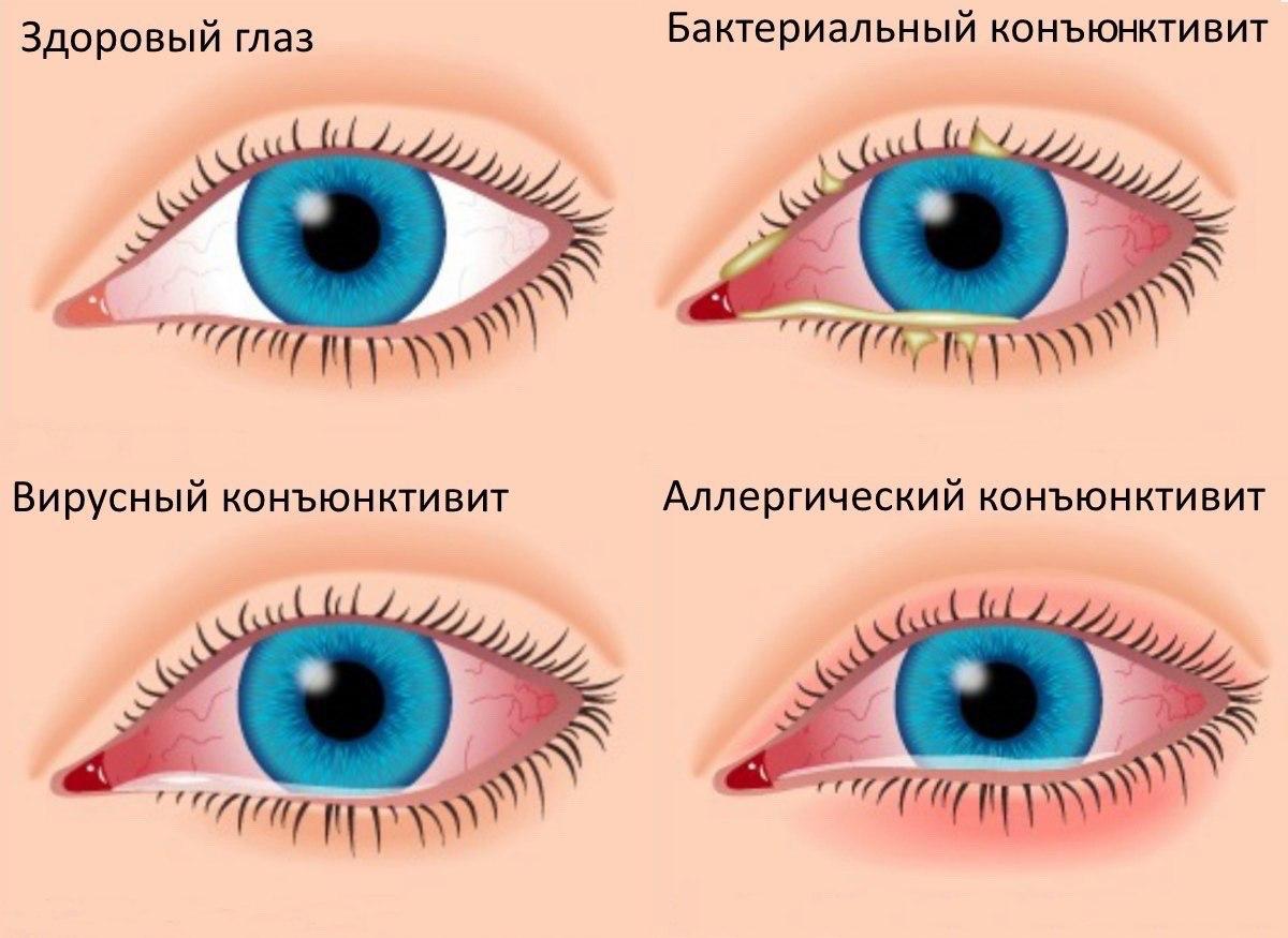 Adenovirus conjunctivitis of the eye