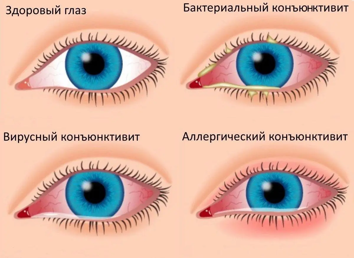 Adenovirus conjunctivitis of the eye