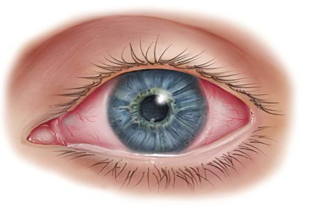 Adenovirus conjunctivitis of the eye