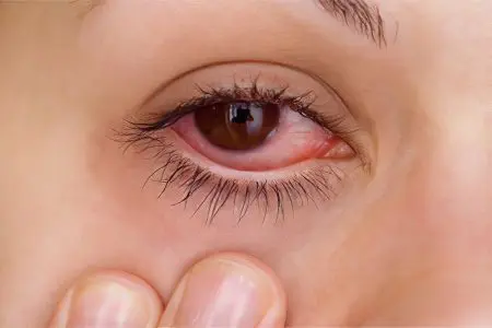 Adenovirus conjunctivitis of the eye