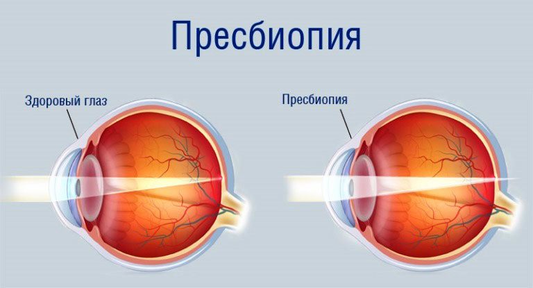 Age-related farsightedness - what to do?