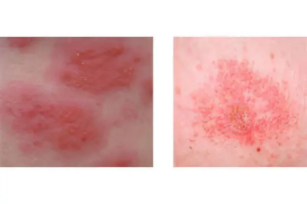 Allergic dermatitis