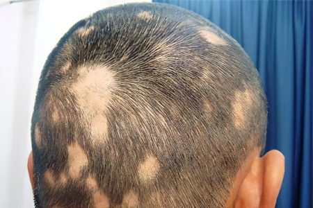 Alopecia areata in children and adults