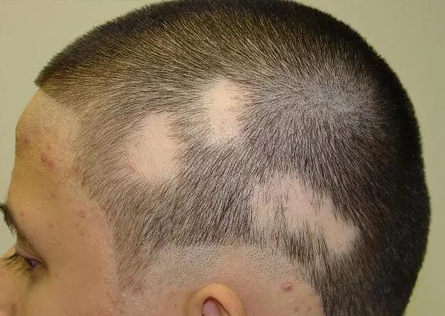 Alopecia areata in children and adults