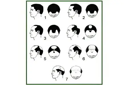 Alopecia (baldness) in men