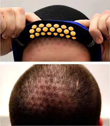 Alopecia (baldness) in men