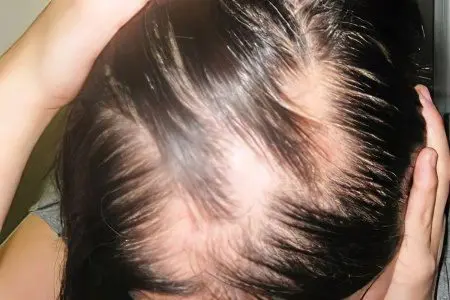 Alopecia (baldness) in women