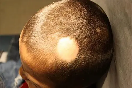 Alopecia in children