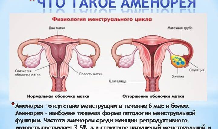 Amenorrhea primary and secondary: causes and treatment