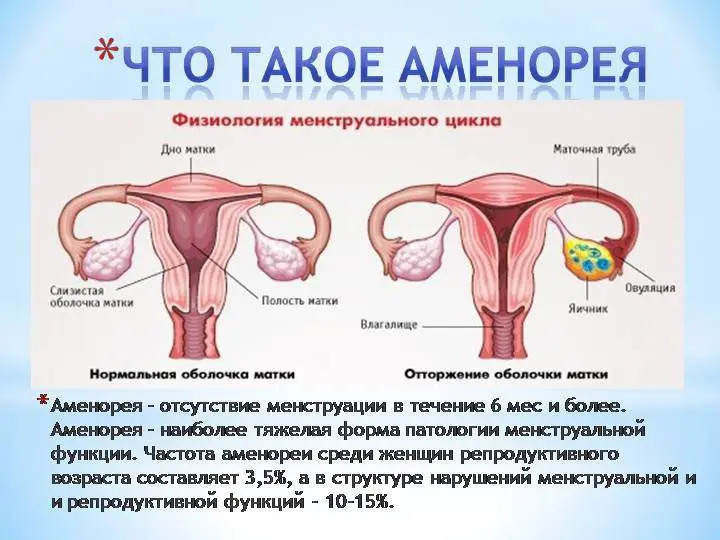 Amenorrhea primary and secondary: causes and treatment