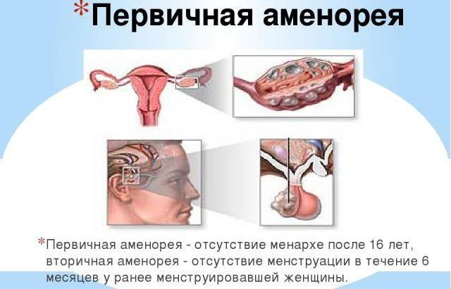 Amenorrhea primary and secondary: causes and treatment