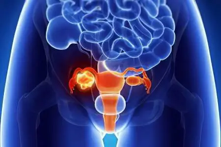 Amenorrhea primary and secondary: causes and treatment