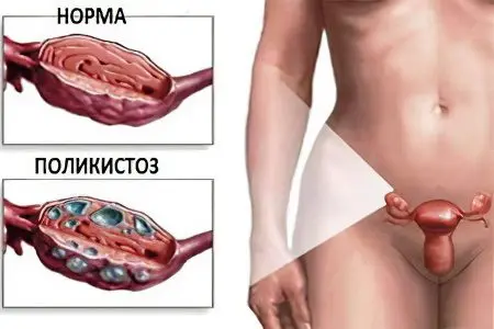 Amenorrhea primary and secondary: causes and treatment