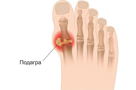 An increase in the level of uric acid in the blood: the norm, causes and symptoms