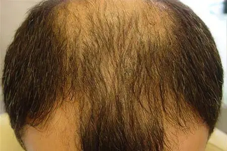 Androgenetic alopecia in men and women