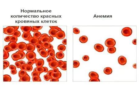 Anemia 1 degree &#8211; what is it and how to treat it?