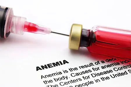 Anemia 2 degrees