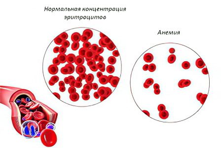 Anemia: causes, types of symptoms and treatment