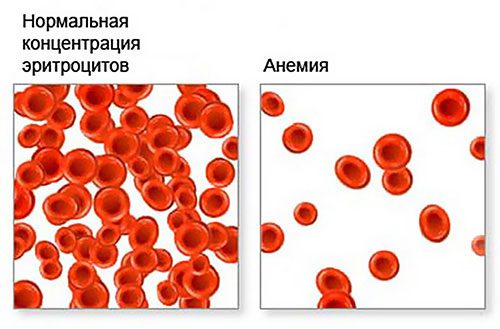 Anemia: causes, types of symptoms and treatment