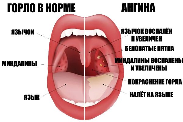 Angina: causes, symptoms and treatment