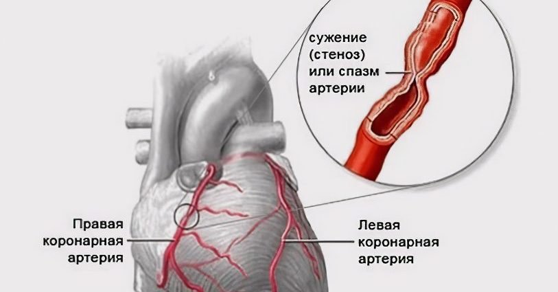 Angina: symptoms and treatment