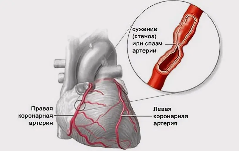 Angina: symptoms and treatment