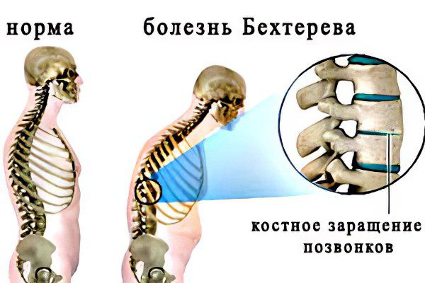 Ankylosing spondylitis in women and men