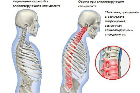 Ankylosing spondylitis: Nîşan û dermankirin