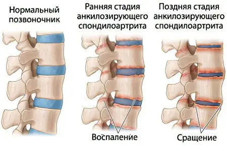 Ankylosing spondylitis: symptoms and treatment