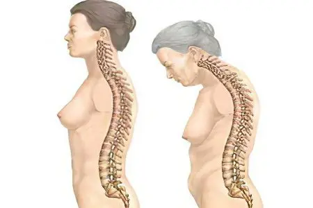 Ankylosing spondylitis: symptoms and treatment