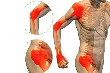 Ankylosing spondylitis: symptoms and treatment
