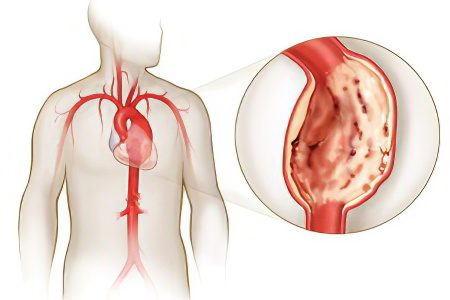 Aortic aneurysm of the heart