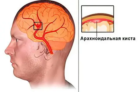 Arachnoid cyst of the brain