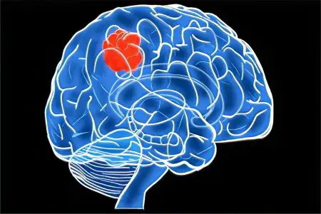 Arachnoid cyst of the brain