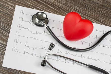 Arrhythmia: causes, types and treatment