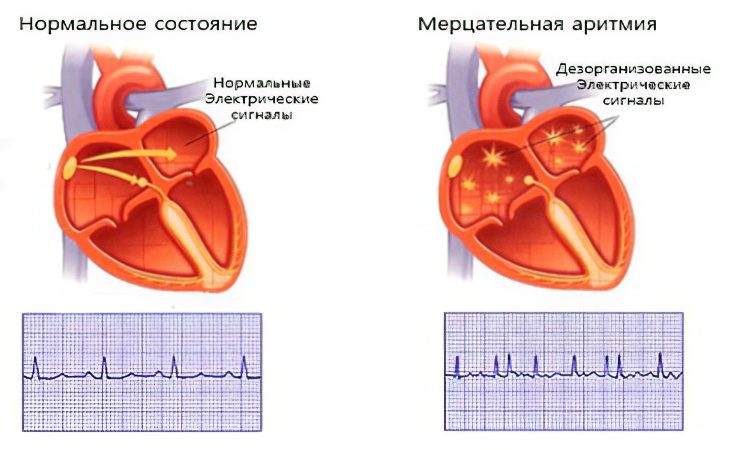 Arrhythmia: causes, types and treatment