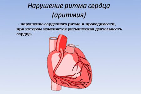 Arrhythmia: causes, types and treatment