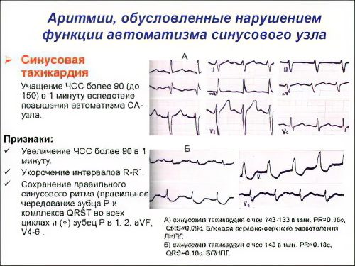 Arrhythmia: causes, types and treatment