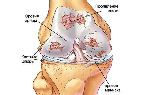 Arthralgia of the knee joint: symptoms and treatment