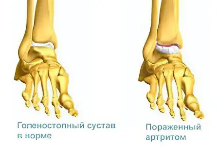 Arthritis of the ankle