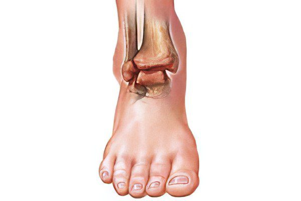 Arthritis of the ankle