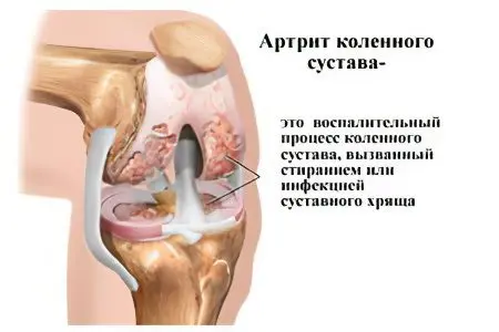 Arthritis of the knee